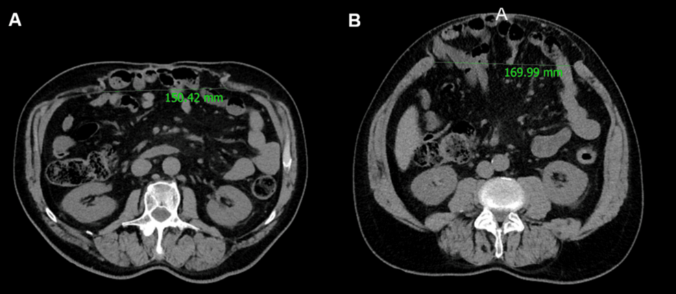 Preoperative-computed-tomography-(CT)-imaging-documenting-the-presence-of-a-giant-incisional-hernia,-with-an-interrectus-dist