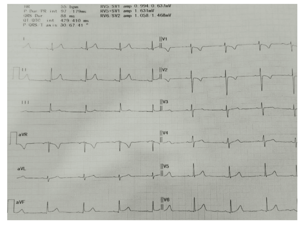 Twelve-lead electrocardiogram with regularly spaced beats. Printed measurements include a heart rate of 55 beats per minute