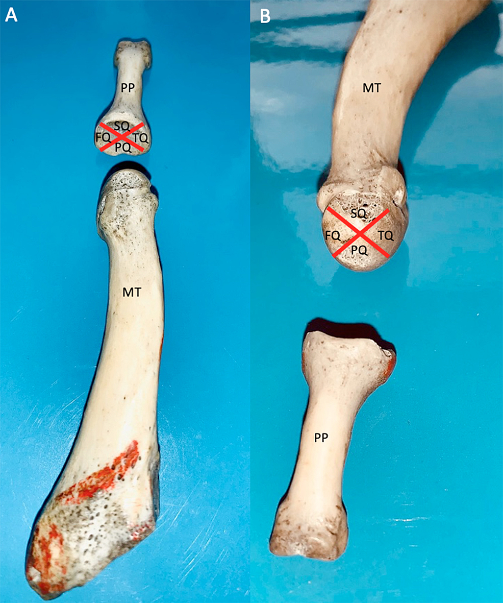 Cureus | Topography of Bone Erosions at the Metatarsophalangeal Joints ...