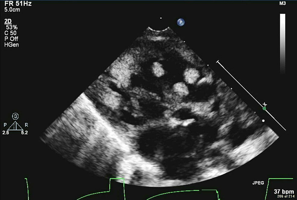 Echocardiography-shows-multiple-echogenic-masses-(five-at-least-seen-in-the-ventricle-and-the-largest-is-9x8)