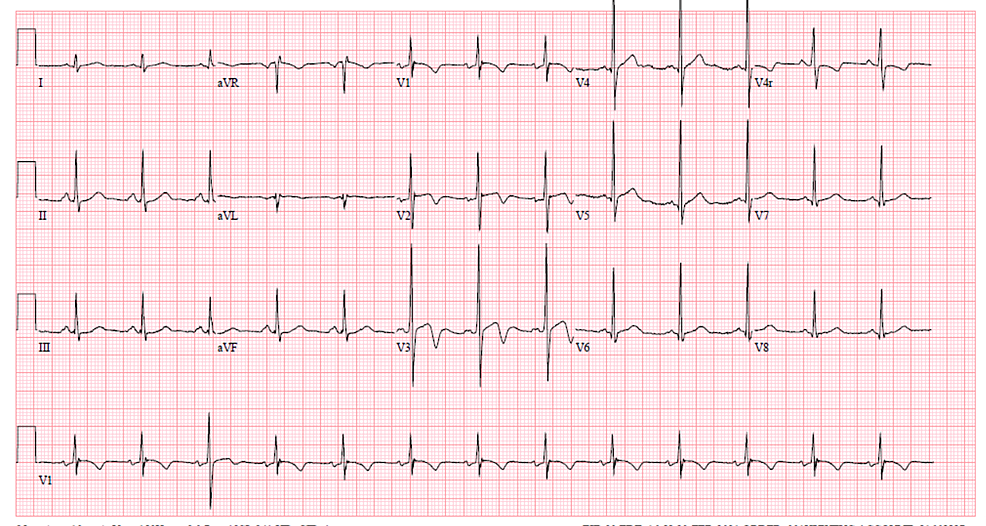 ECG-shows-sine-rhythm-and-nonspecific-T-wave-abnormalities