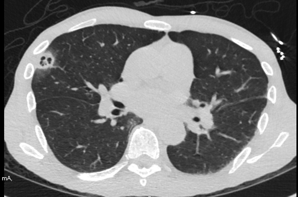 CT-chest-shows-peripheral-cavitary-opacities-in-the-right-upper-lobe-