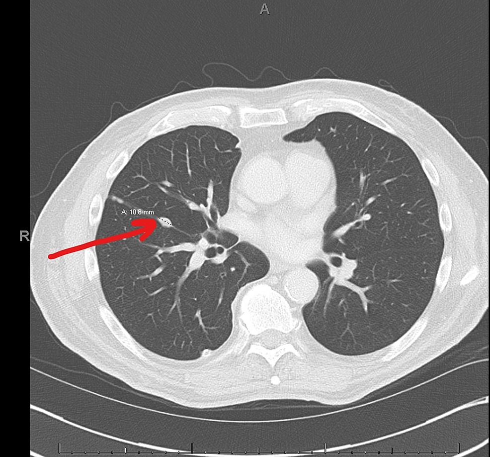 Preoperative-chest-CT-following-neoadjuvant-chemotherapy-demonstrating-10.8-mm-nodule-in-the-right-lung