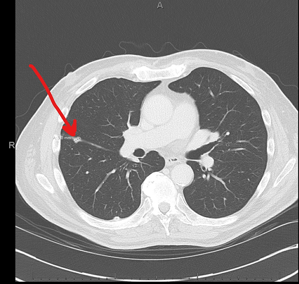 Preoperative-chest-CT-following-neoadjuvant-chemotherapy-demonstrating-9-mm-nodule-in-the-right-lung