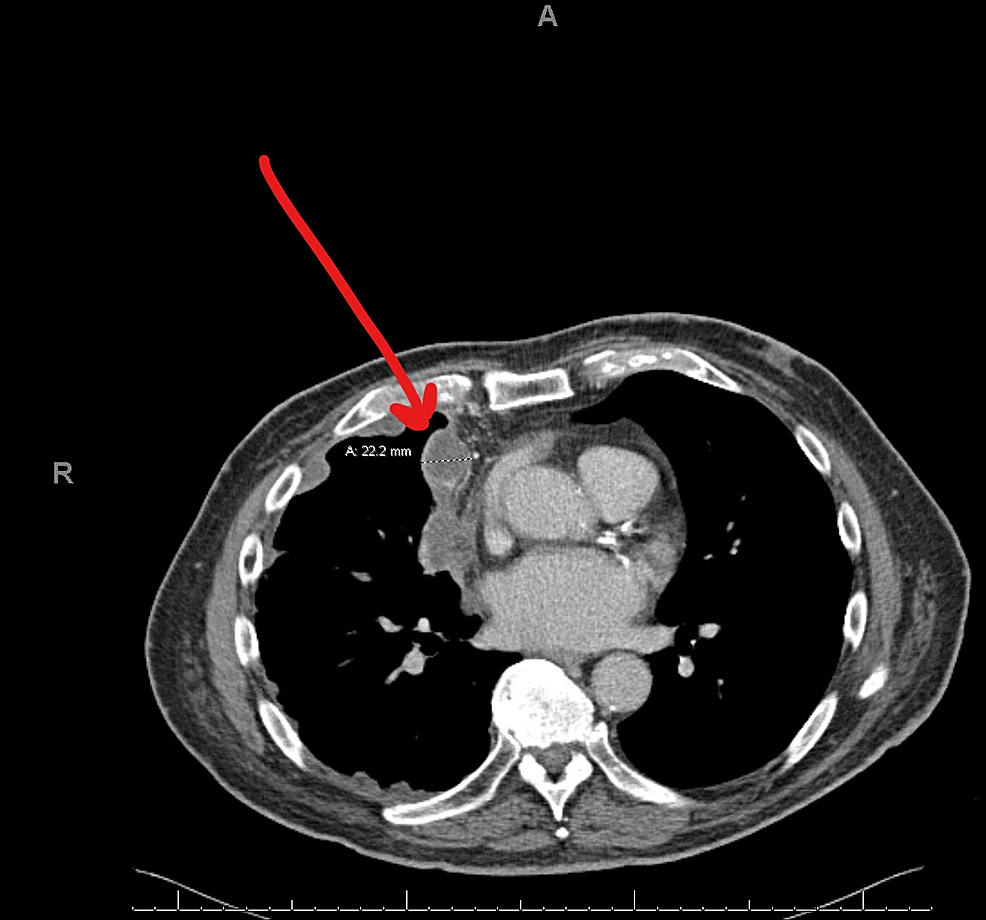 Chest-CT-examining-the-progression-of-the-disease-with-the-pleural-based-mass-measuring-2.3-cm-×-4.4-cm-abutting-the-right-atrium