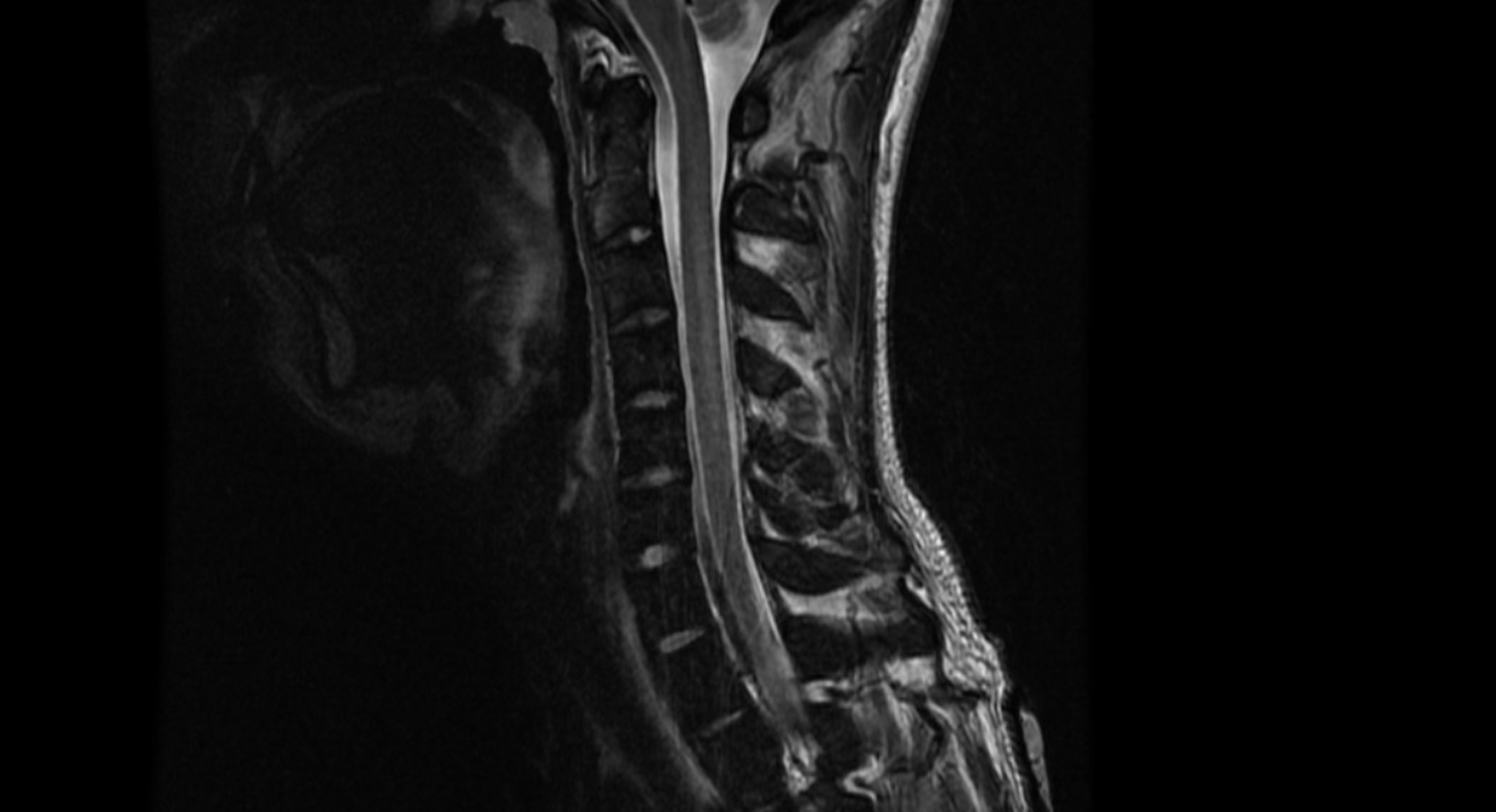 Cureus Recreational Nitrous OxideInduced Subacute Combined