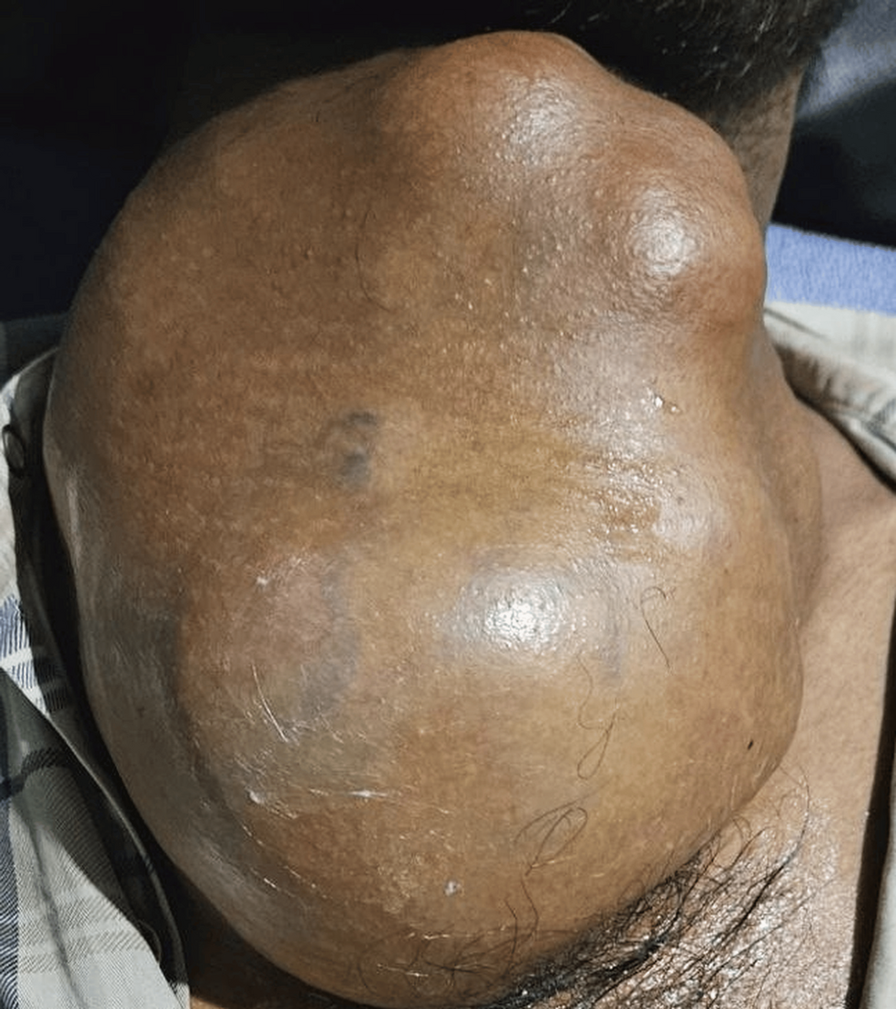 A large, multilobulated swelling occupies the front of the neck, causing the skin over it to stretch smoothly without any