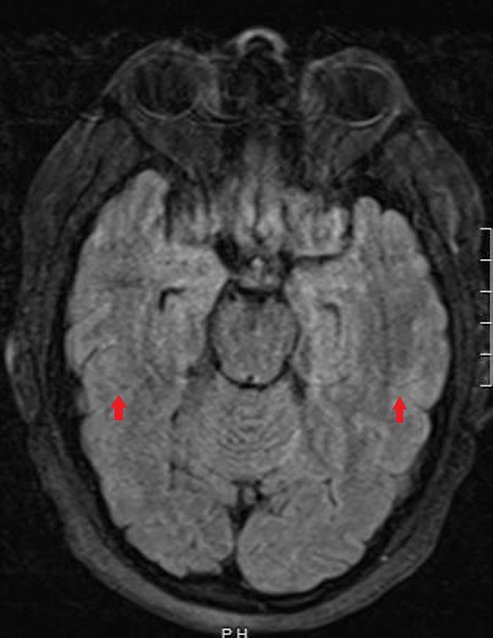 ECT Electroconvulsive Therapy - WVU Medicine Health Report 