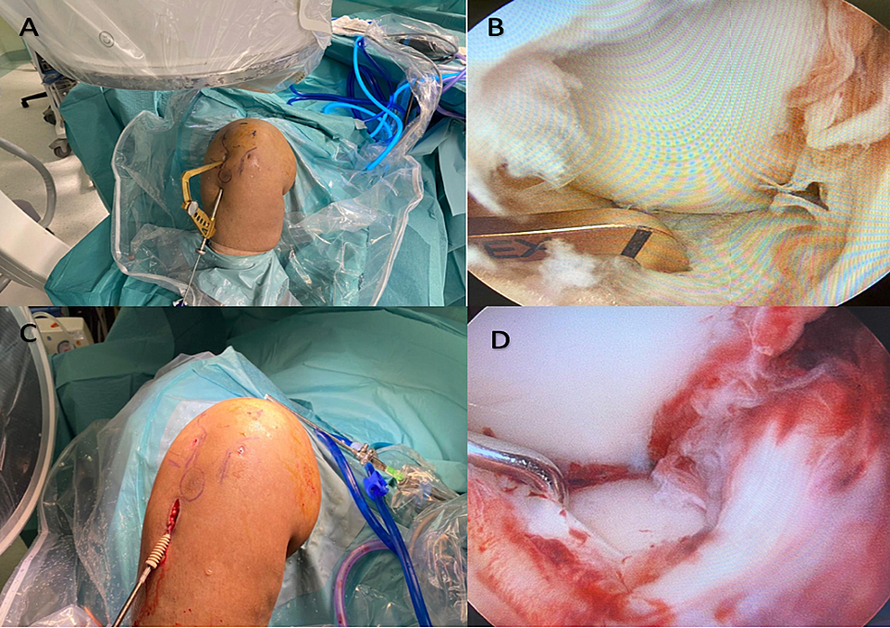Clinical-images-of-the-right-knee:-A,-The-ACL-tibia-guide-is-used-to-direct-the-guide-wire-into-the-fractured-lateral-tibia-plateau.-B,-Arthroscopic-image-confirming-the-position-of-the-ACL-tibia-guide-at-the-fractured-fragment.-C,-Bioabsorbable-interference-screw-is-used-after-fracture-reduction-and-bone-grafting-were-done-(screw-size-10).-D,-Final-arthroscopic-image-confirming-the-reduction-of-the-fracture.