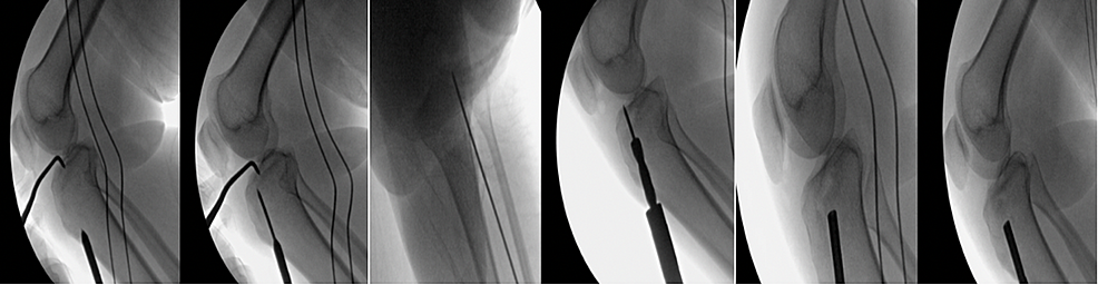 Serial-of-fluoroscopic-images-showing-the-surgical-technique-using-the-ACL-tibia-guide-and-reamer-(size-8).-A-bone-graft-and-a-bone-impactor-were-also-used-to-achieve-joint-reduction.