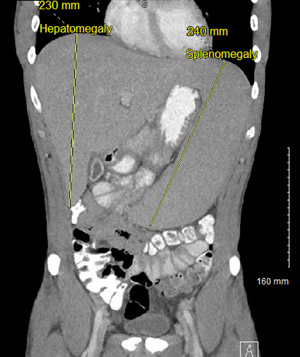 Contrast-enhanced-CT-abdomen-and-pelvis-(coronal-view)-demonstrating-hepatosplenomegaly.