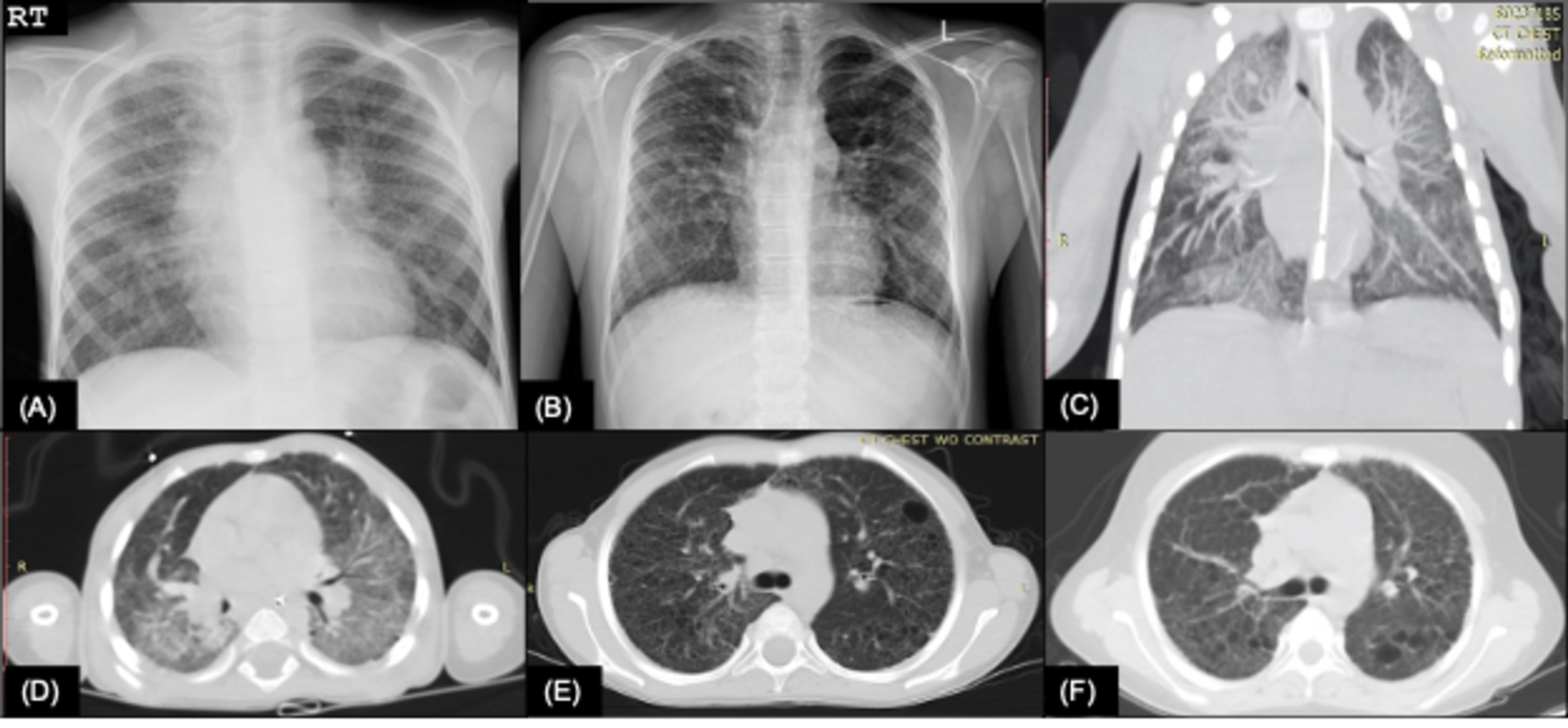 Cureus Surfactant Protein C Deficiency in a Puerto Rican Adolescent