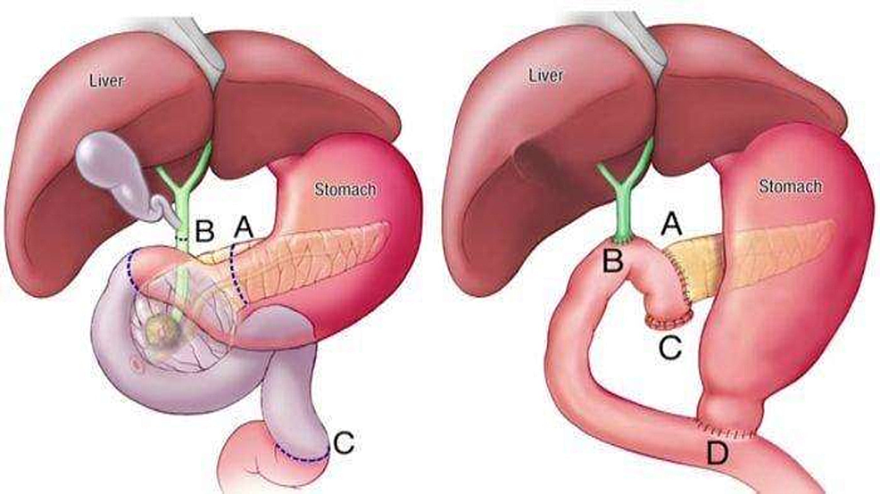 cureus-percutaneous-transhepatic-bowel-stent-deployment-an