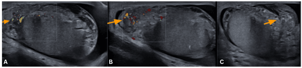 Subacute testicular torsion misidentified as epididymitis in patient