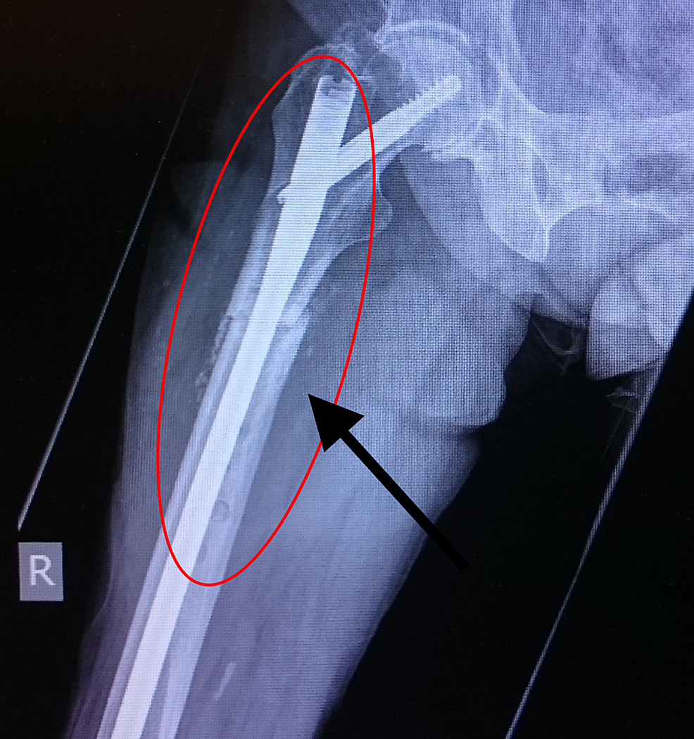 Cureus Bisphosphonateinduced Atypical Femoral Shaft Fracture