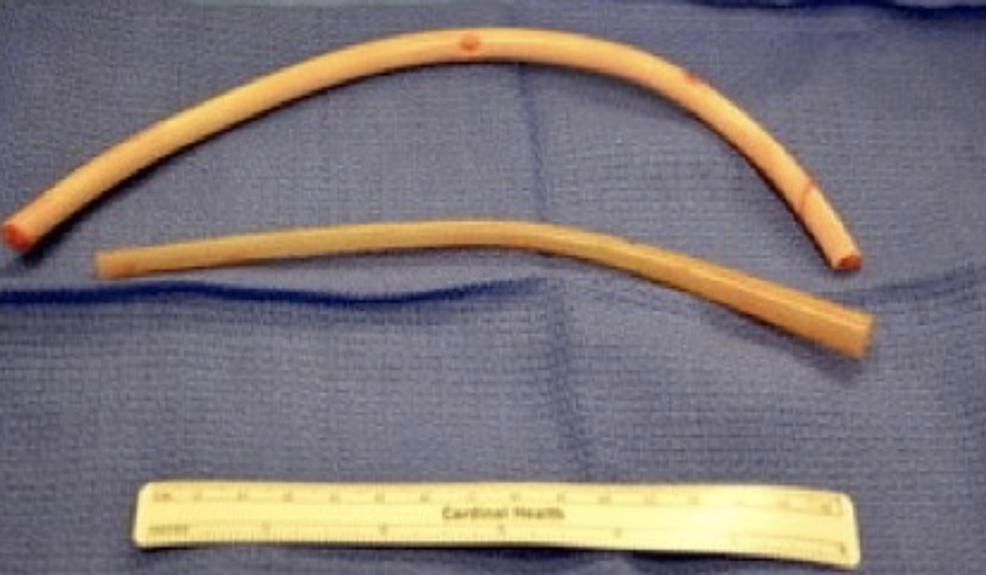 Cureus Abdominal Drains Retrieved Laparoscopically 15 Years Post