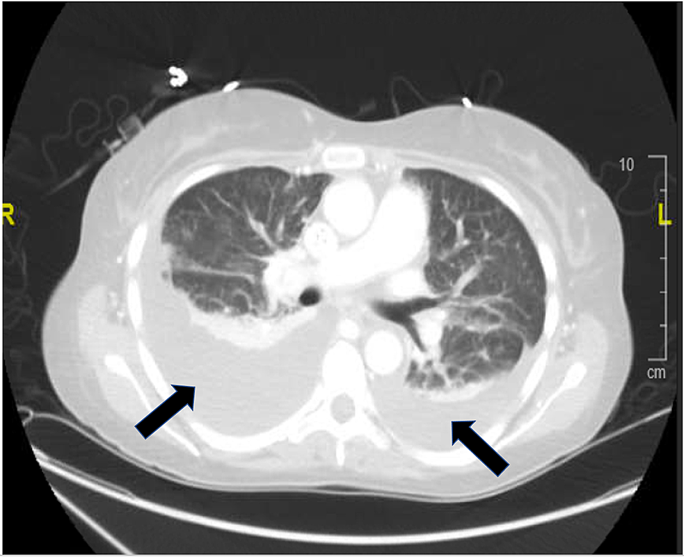 CT-chest,-transverse-section,-demonstrating-bilateral-pleural-effusions-(black-arrows,-right-larger-than-left).