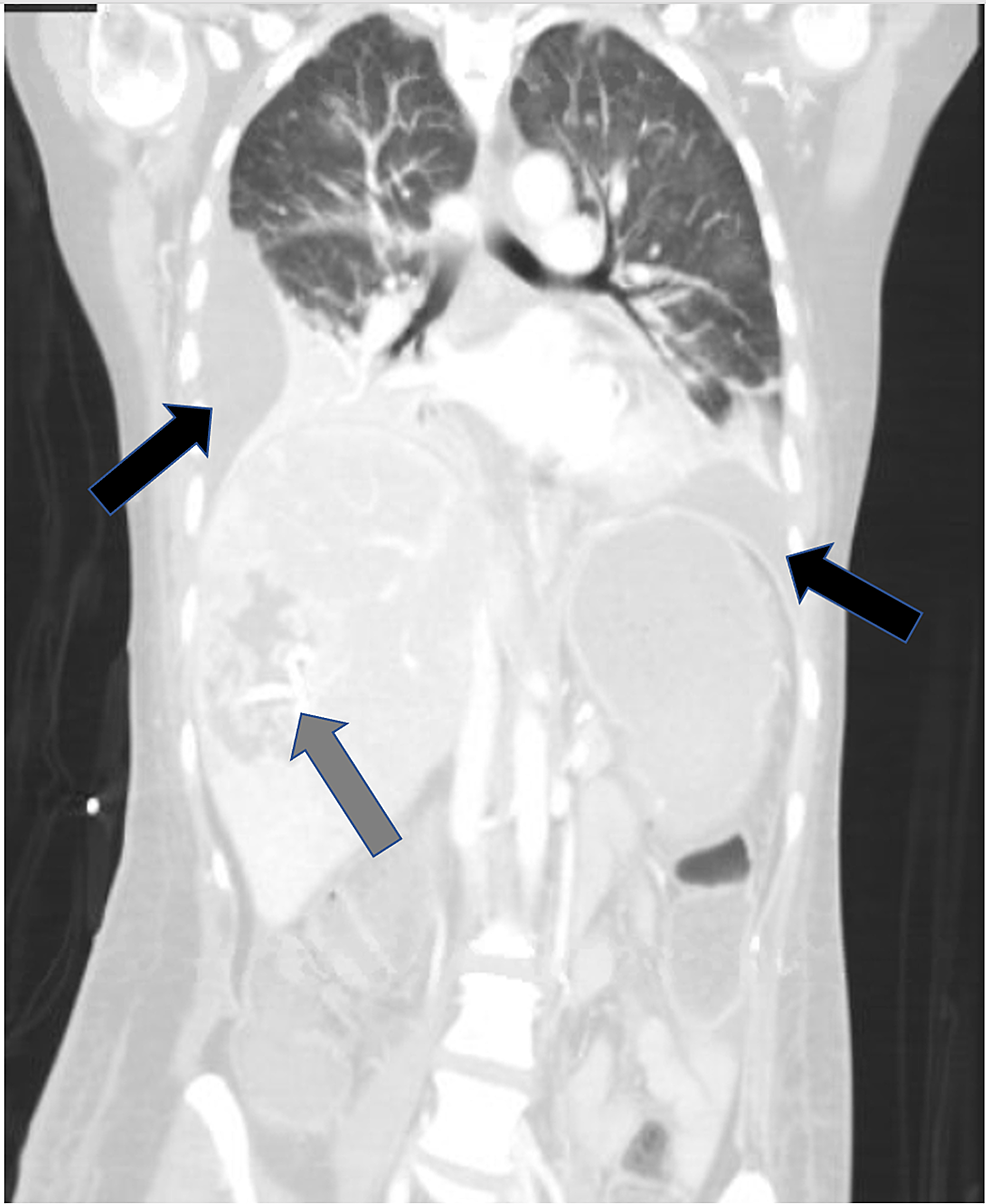 CT-chest-and-abdomen,-coronal-section,-demonstrating-bilateral-pleural-effusions-(black-arrows),-right-hemidiaphragm-elevation-secondary-to-hepatomegaly-with-drain-(gray-arrow)-in-right-hepatic-lobe-abscess.