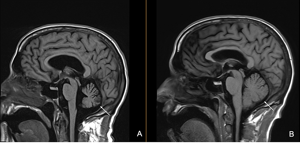 One-year-follow-up-MRI-of-the-brain.