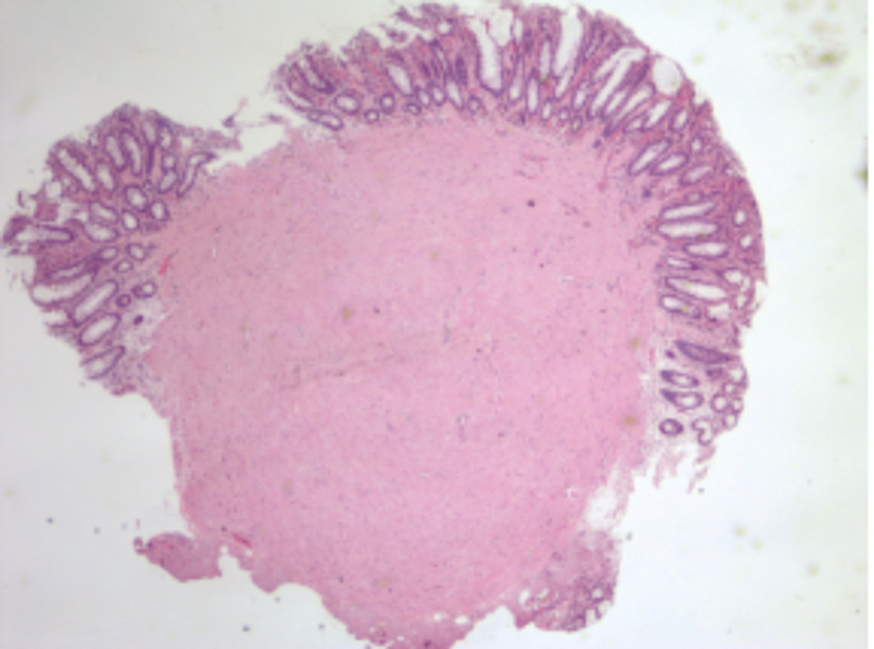 Cureus | Leiomyoma in the Transverse Colon With Resection