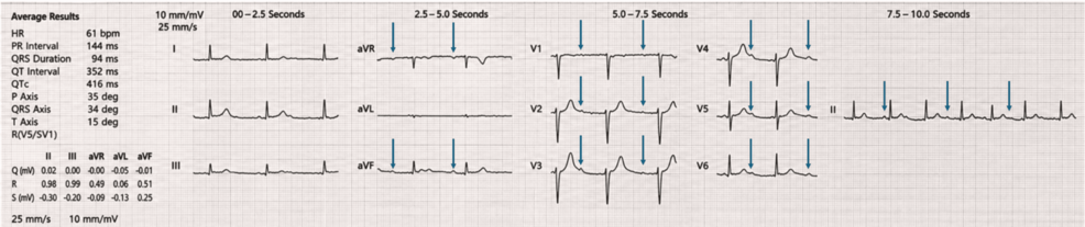 Multivalvular Infective Endocarditis Presenting as Complete Heart Block and Neurological Features Mimicking Meningoencephalitis