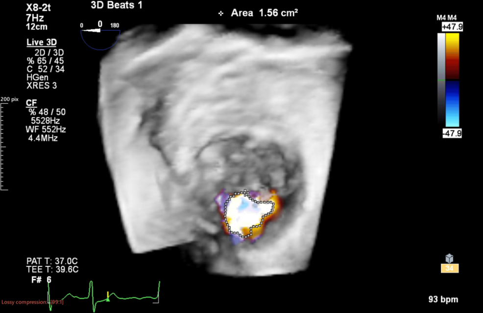 Three-dimensional-assessment-of-tricuspid-regurgitation-using-intraoperative-transesophageal-echocardiography.