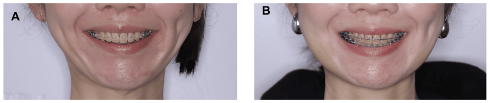 The images compare the dental alignment and jaw position of a patient before and six months after orthognathic surgery