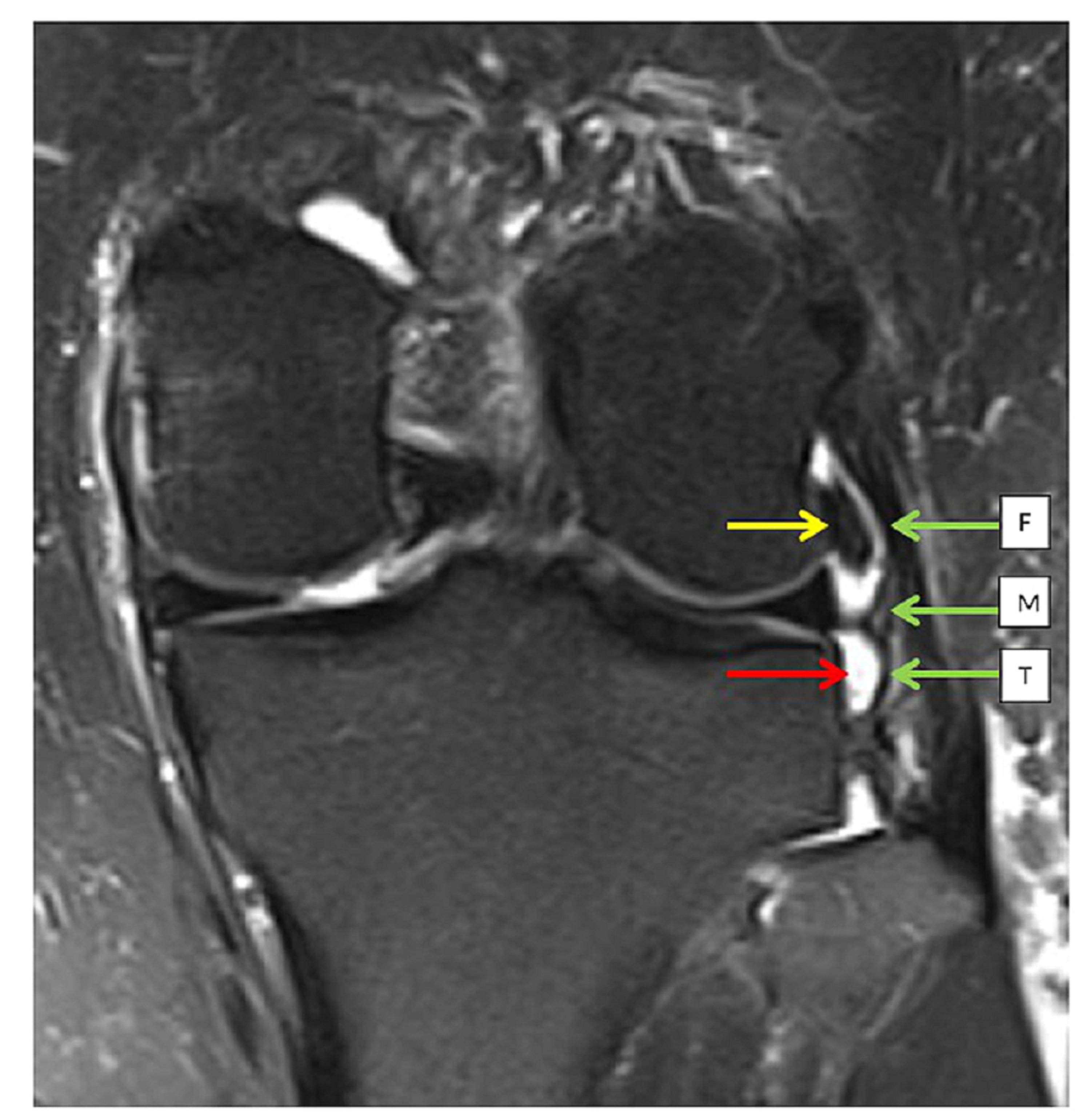 anterior cruciate ligament mri