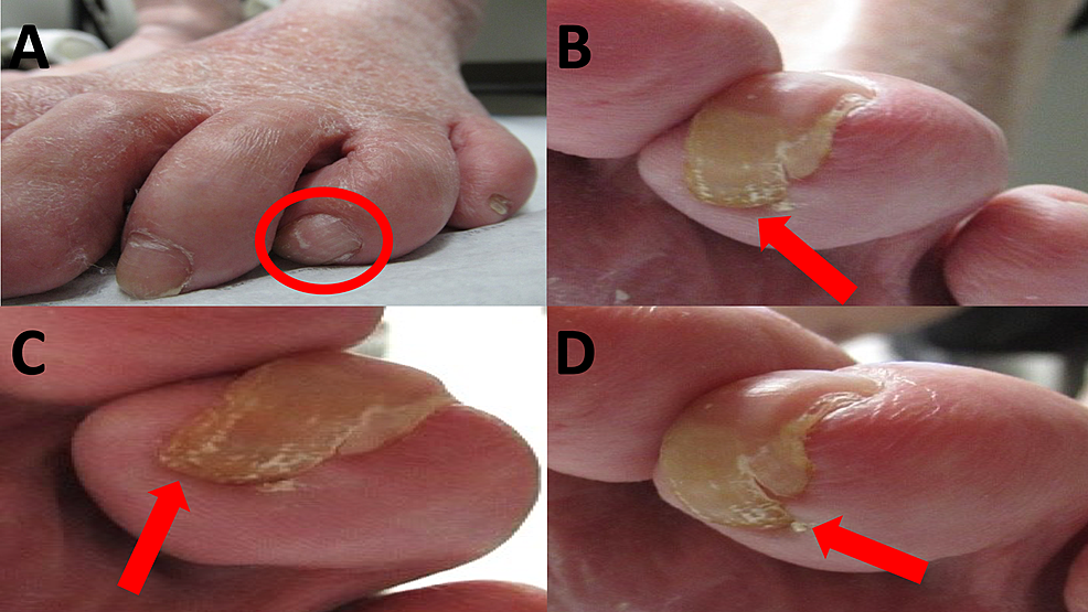 Parrot Beak Nails Revisited Case Series and Comprehensive Review   Dermatology and Therapy