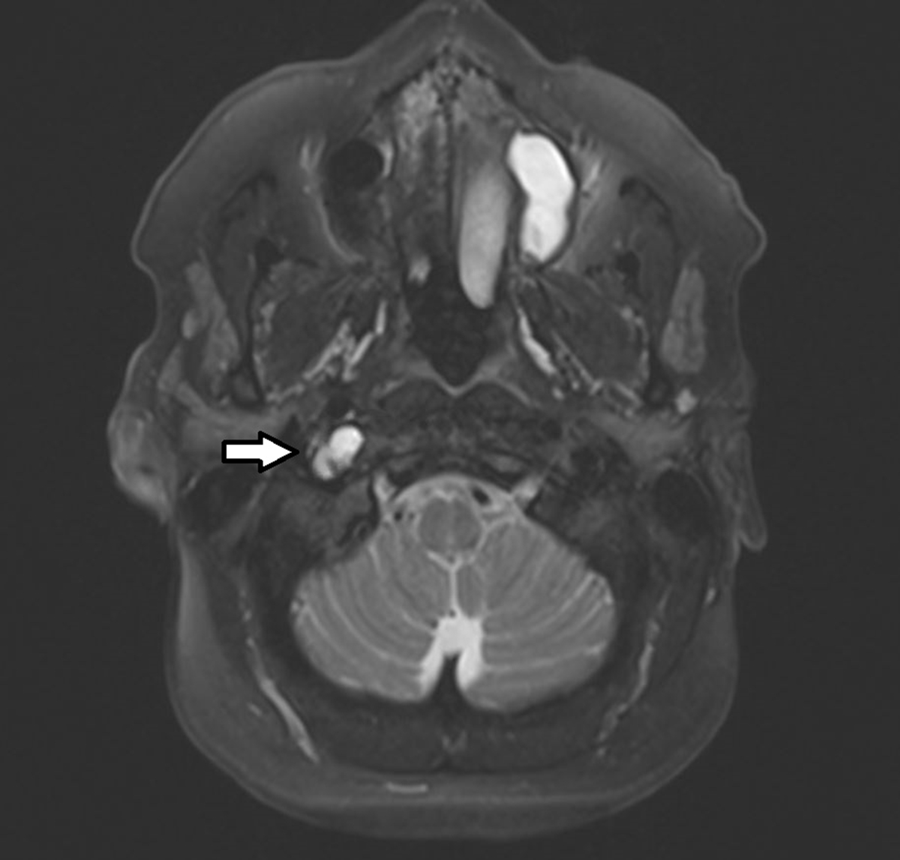 Cureus | Unusual Stroke-Like Symptoms in a Patient With Generalized ...