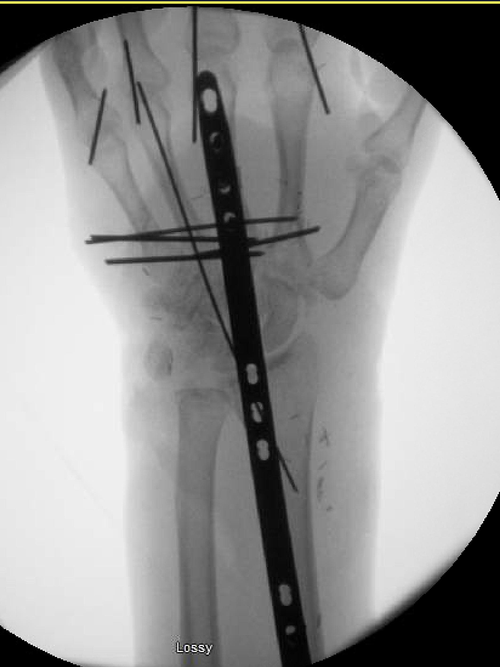 -X-ray-showing-stabilization-of-the-metacarpal-fractures-with-K-wires-and-a-spanning-wrist-plate-placed-to-stabilize-the-wrist.