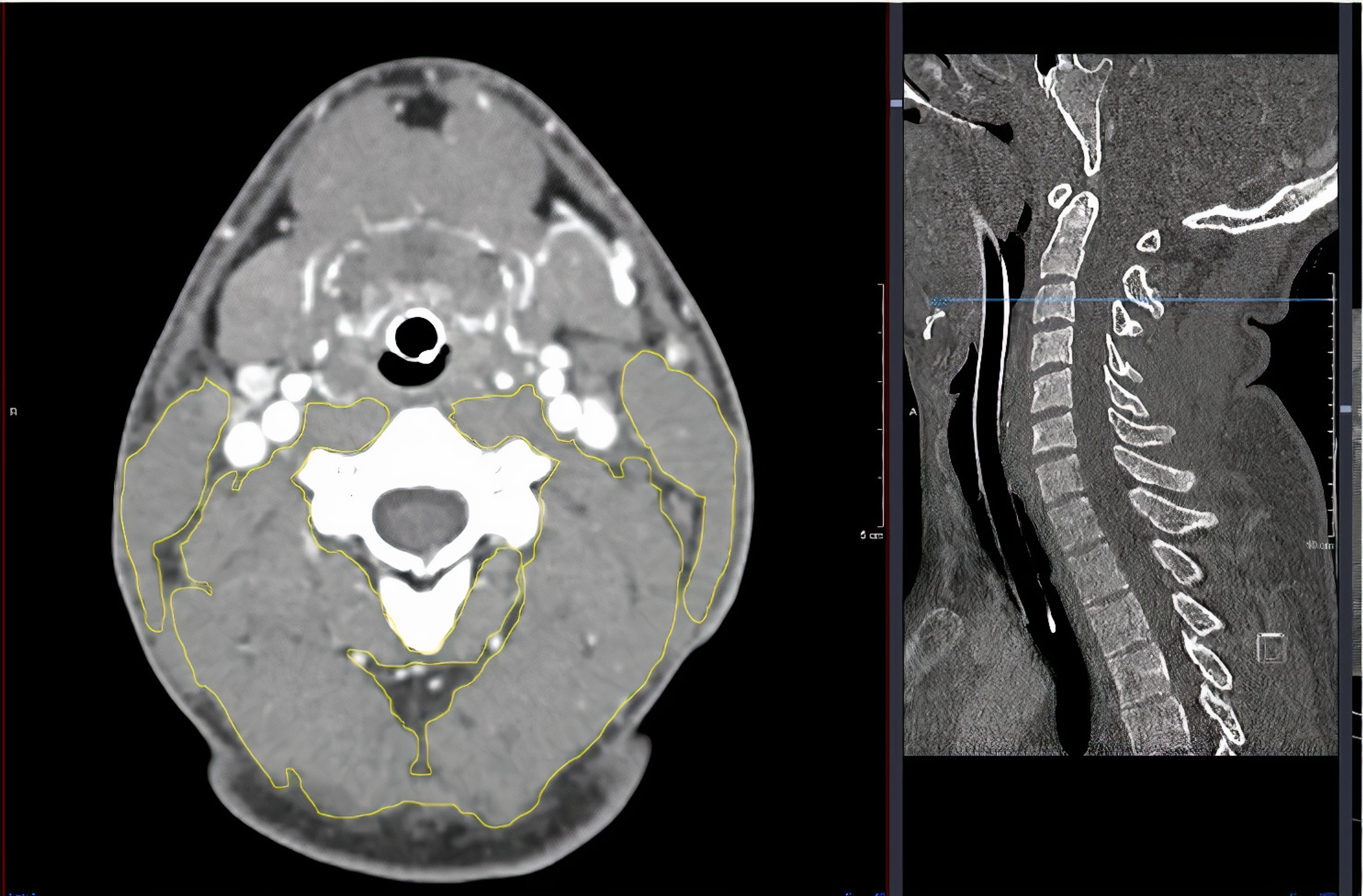 Cureus Muscle Quantity At C3 And Or L3 On Routine Trauma Series Computed Tomography Correlate With Brain Frailty And Clinical Frailty Scale A Cross Sectional Study