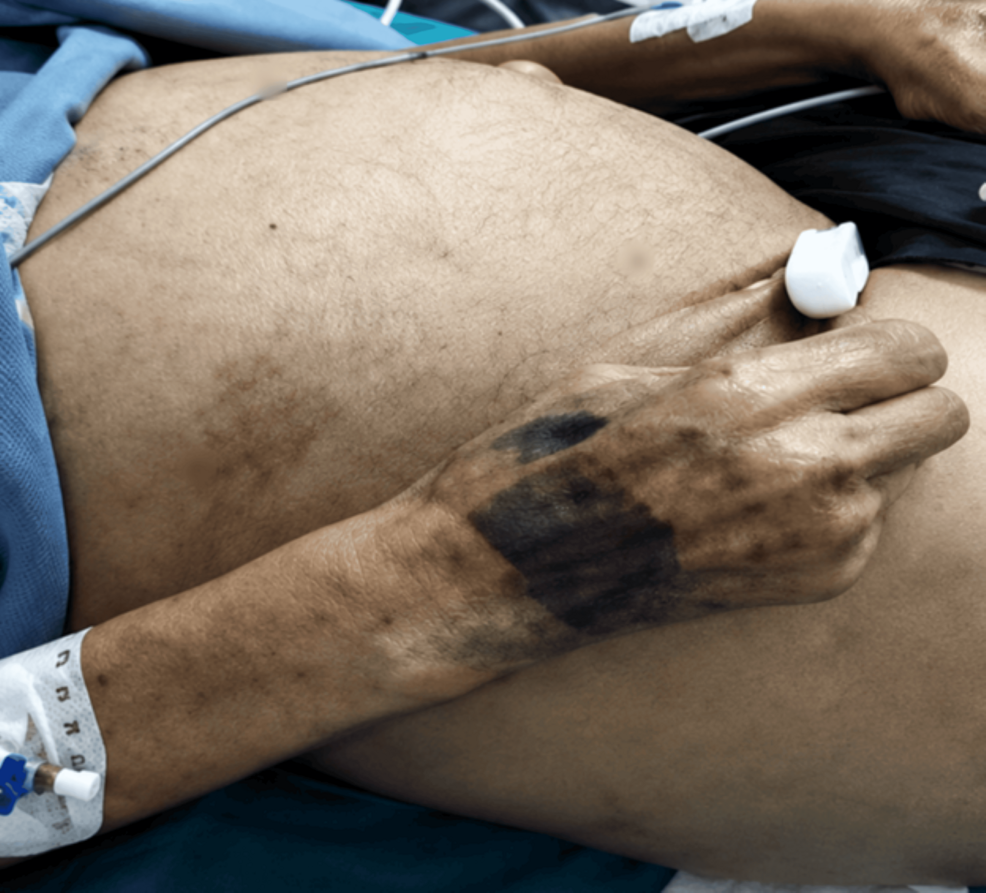 Clinical-photograph-showing-marked-abdominal-distension-in-the-bedridden-patient,-with-cardiorespiratory-monitoring-and-intra