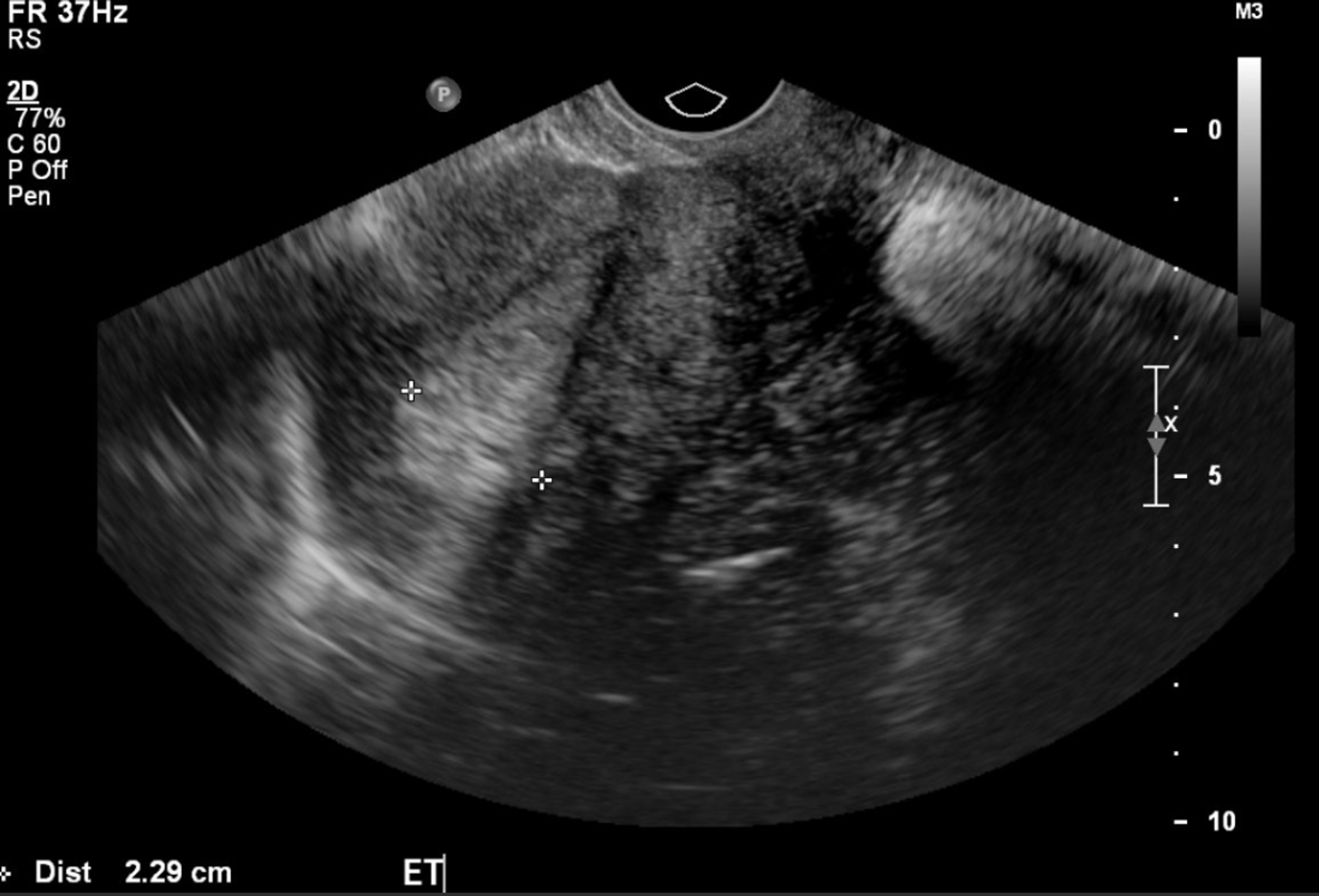 Cureus Ciliated Cell Variant Of Endometrial Carcinoma In An Adenomyoma In Uterus