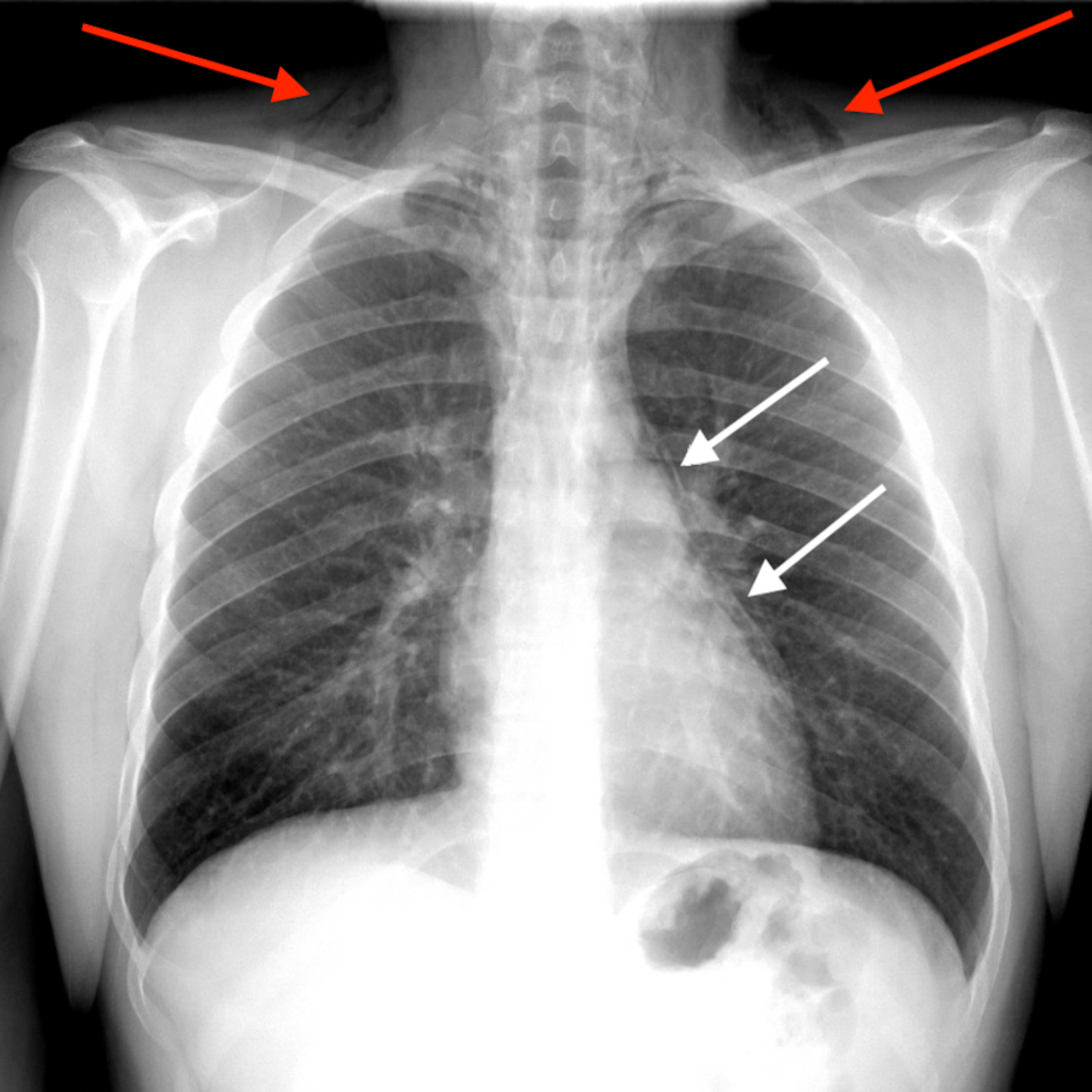 Chest X Ray With Pneumomediastinum And Subcutaneous Emphysema Arrows