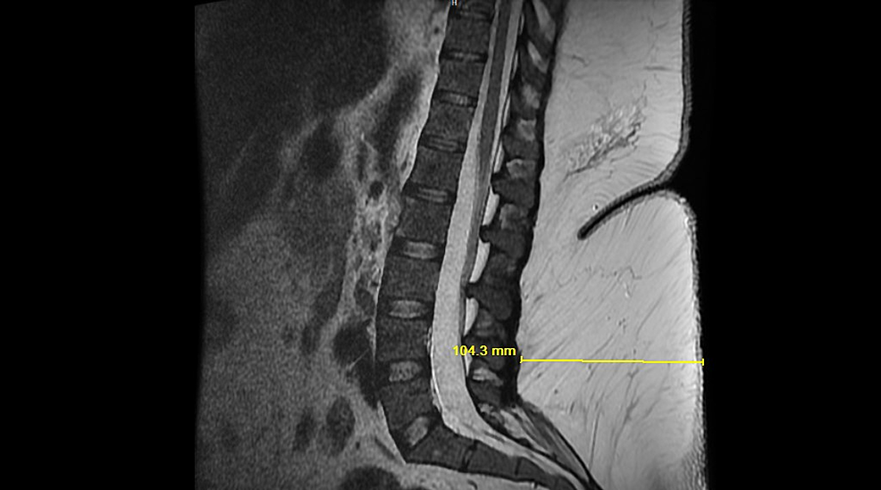 MRI-Lumbosacral-Spine