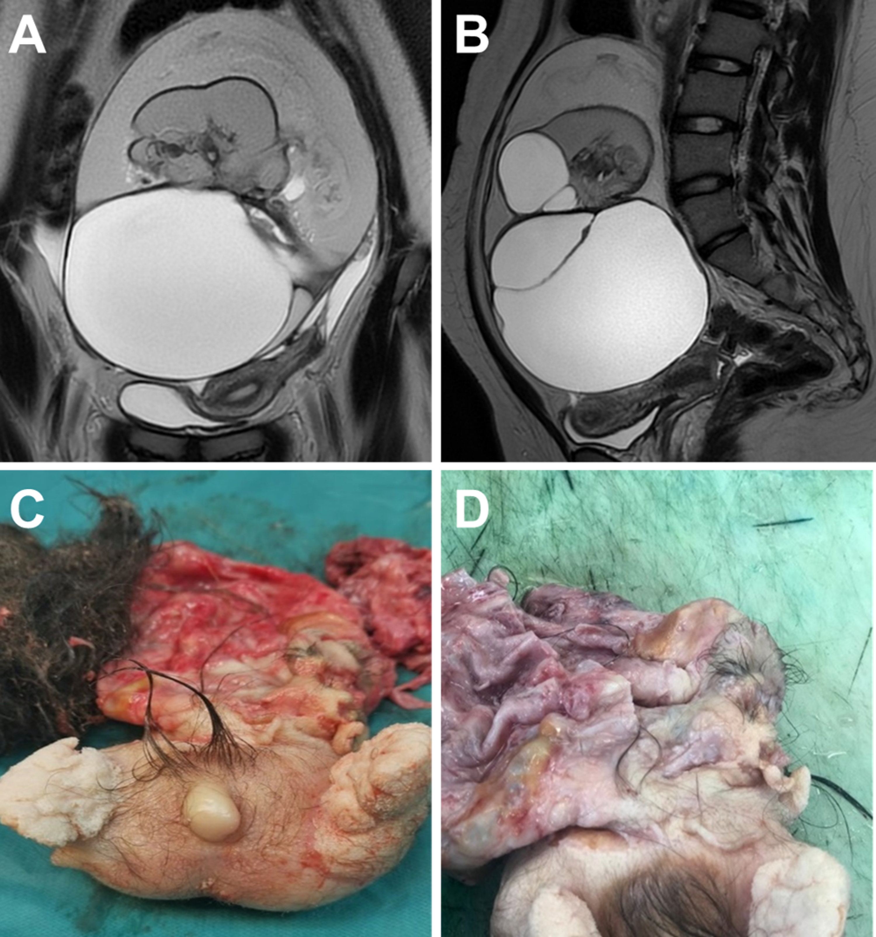 Cureus | Ovarian Fetiform Teratoma in a 17-Year-Old Adolescent Girl |  Article