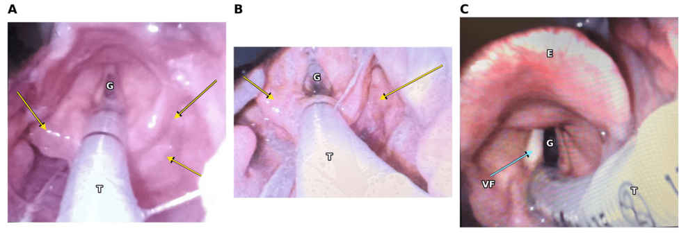 Marked swelling of the tissue around the glottic opening is visible on day 0, indicated by arrows pointing to the swollen