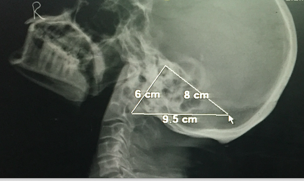 Lateral-radiograph-of-skull-showing-the-mastoid-triangle-related-measurements