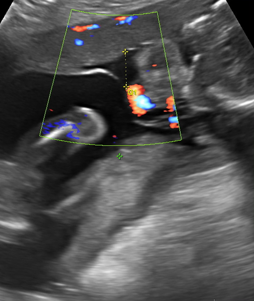 premature rupture of membranes at 32 weeks gestation