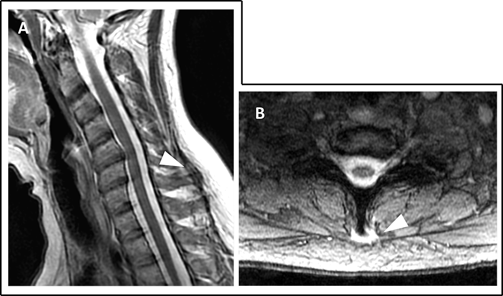 Cervico-thoracic Interspinous Bursitis Associated with Bilateral Upper ...