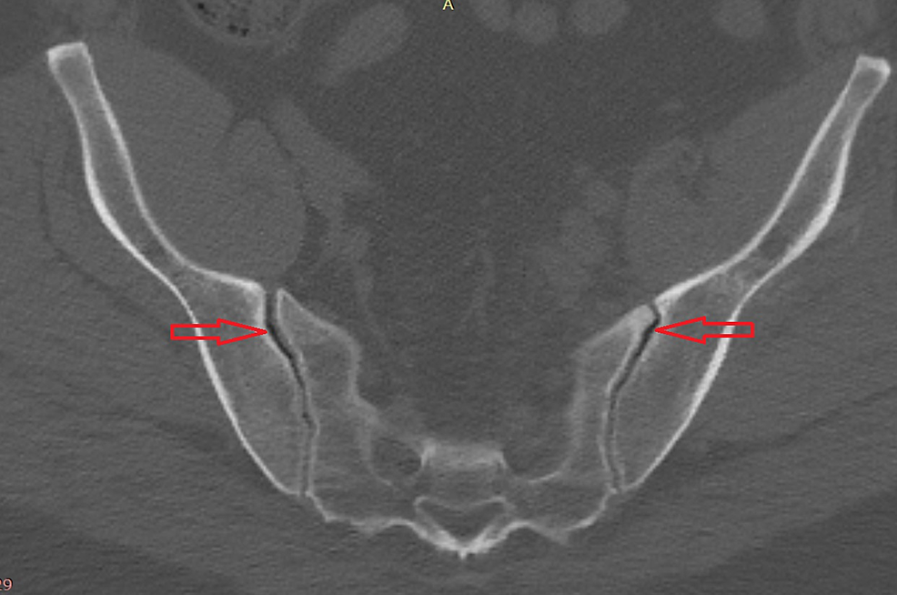 CT Scan and Clinical of Novel LateralOblique Percutaneous