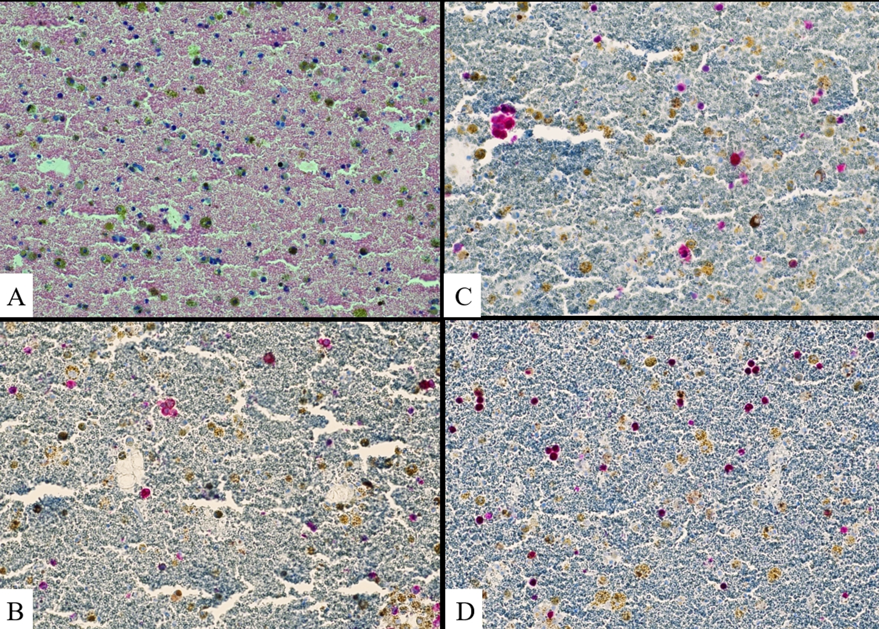 Cureus Diffuse Alveolar Hemorrhage An Unusual Presentation Of Recurrent Malignant Melanoma