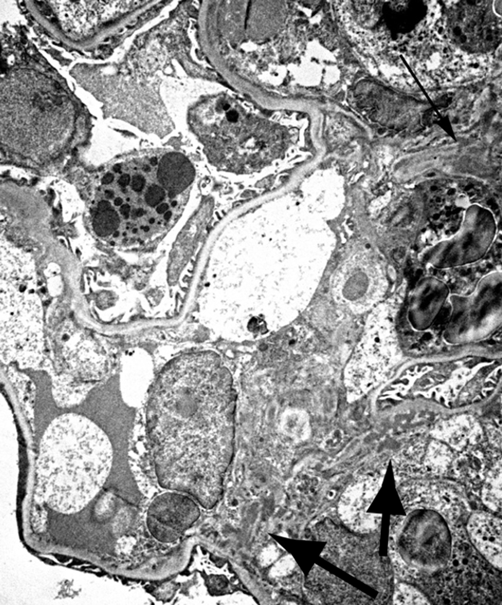 Acute Rheumatic Fever and Acute Post Streptococcal