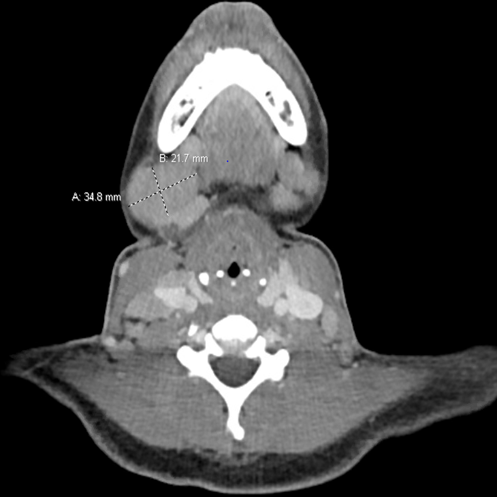 Cureus AdultOnset Still’s Disease With Extensive Lymphadenopathy