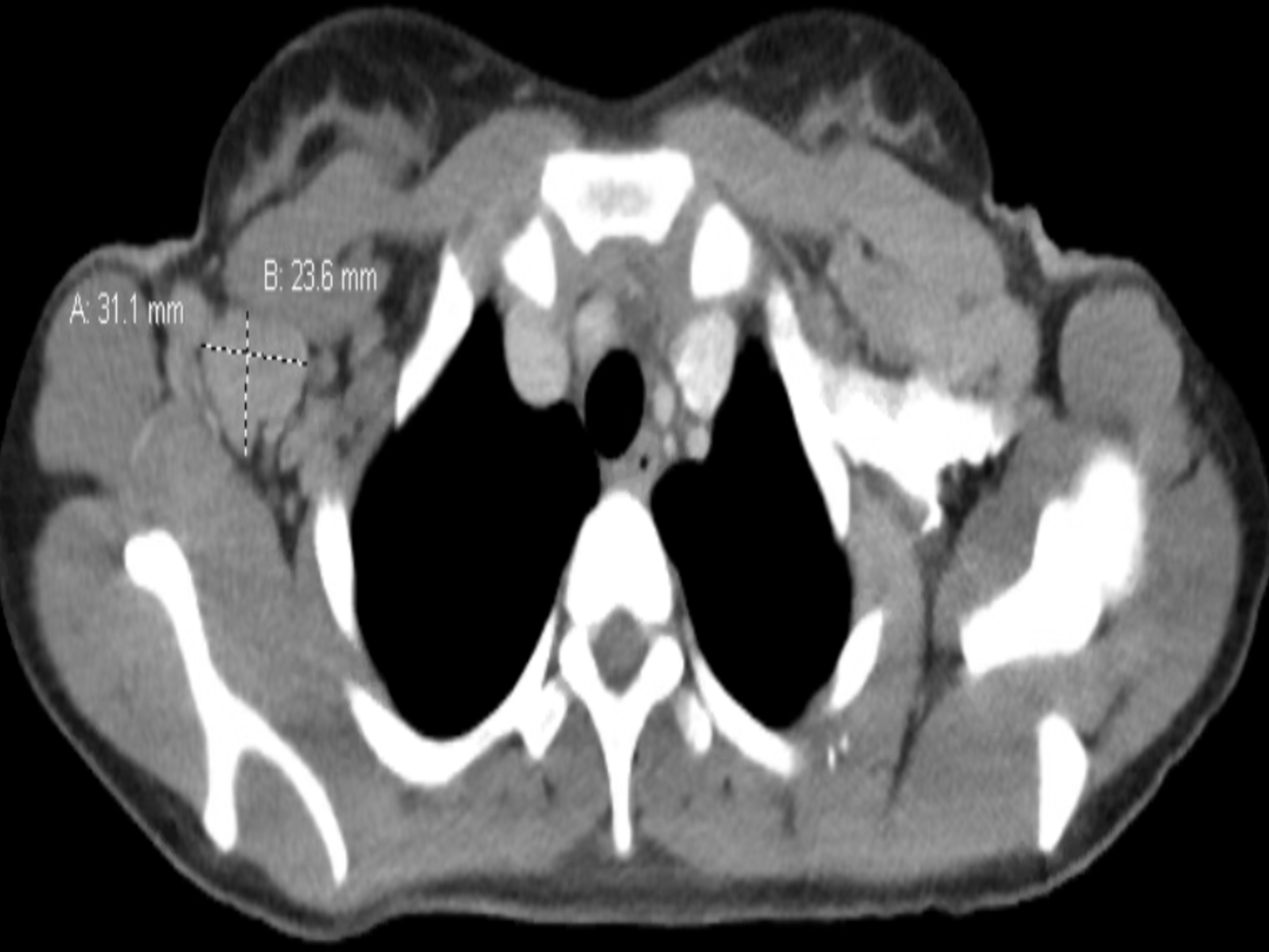 Ct Scan Of Chest Showing Bilateral Enlarged Axillary vrogue.co