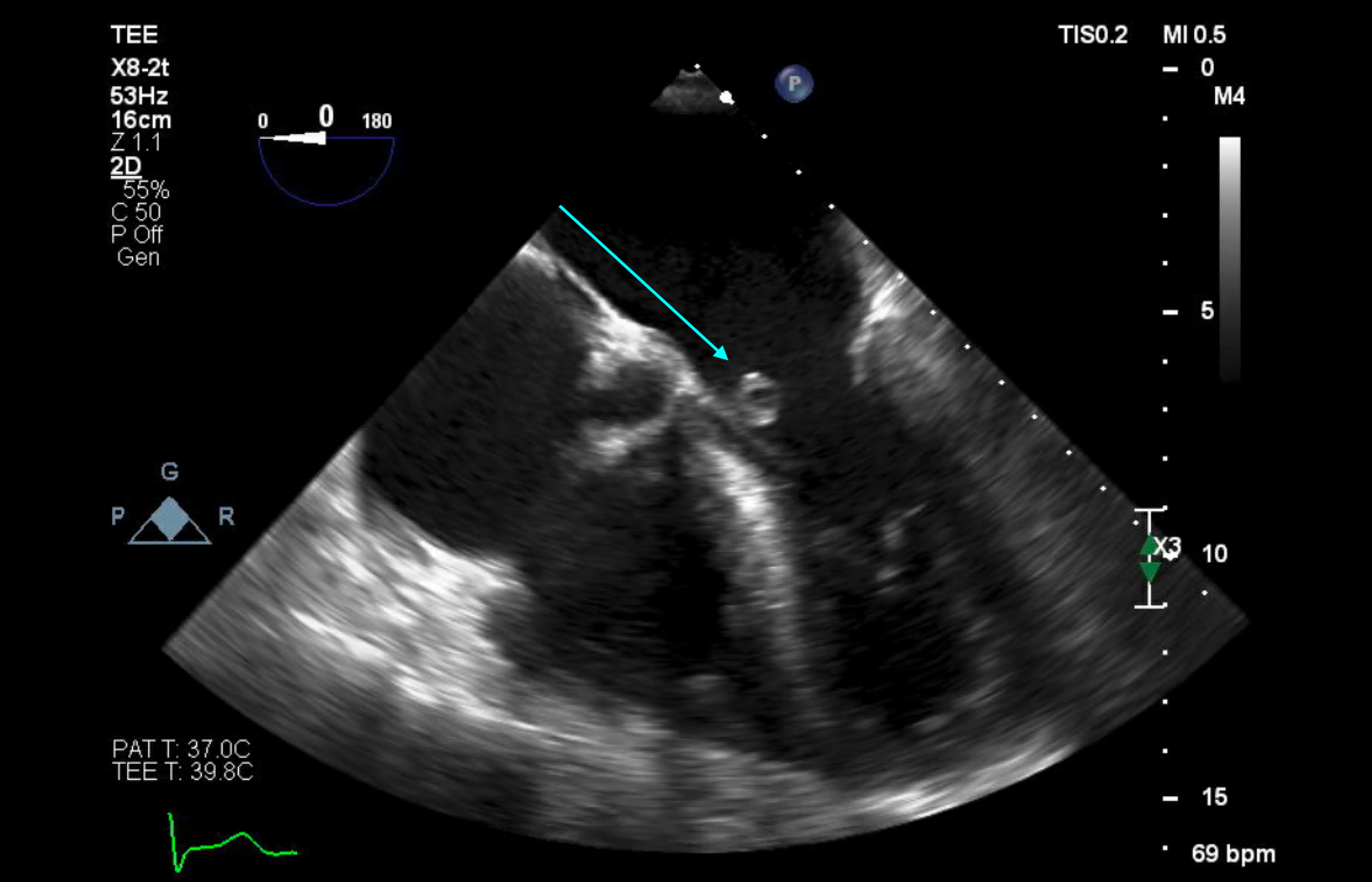 Cureus | Staphylococcus capitis Endocarditis of a Native Valve