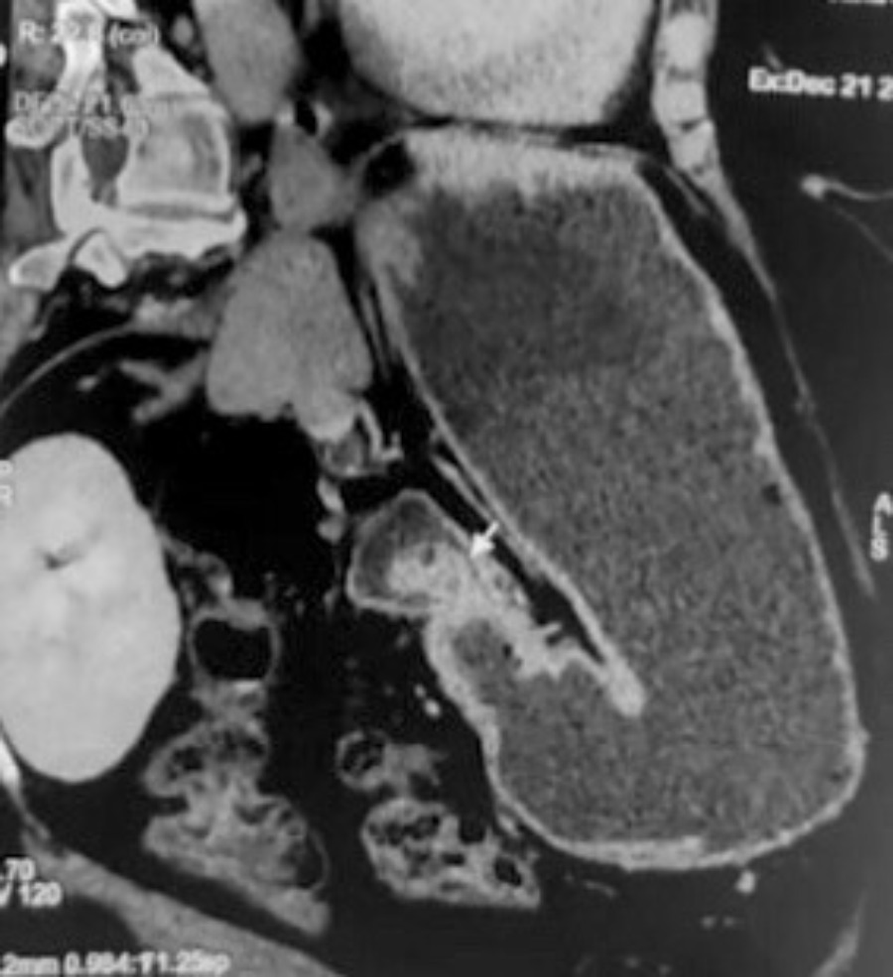 Cureus Massive Upper Gastrointestinal Hemorrhage in Brunner’s Gland