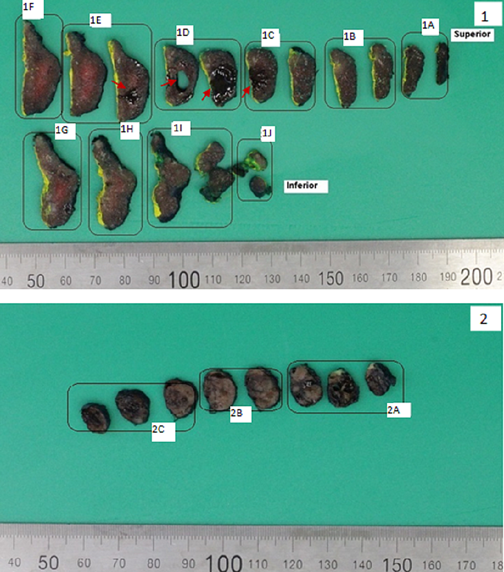 Intra-Thyroid Thyroglossal Duct Cyst Incidentally Identified in an ...