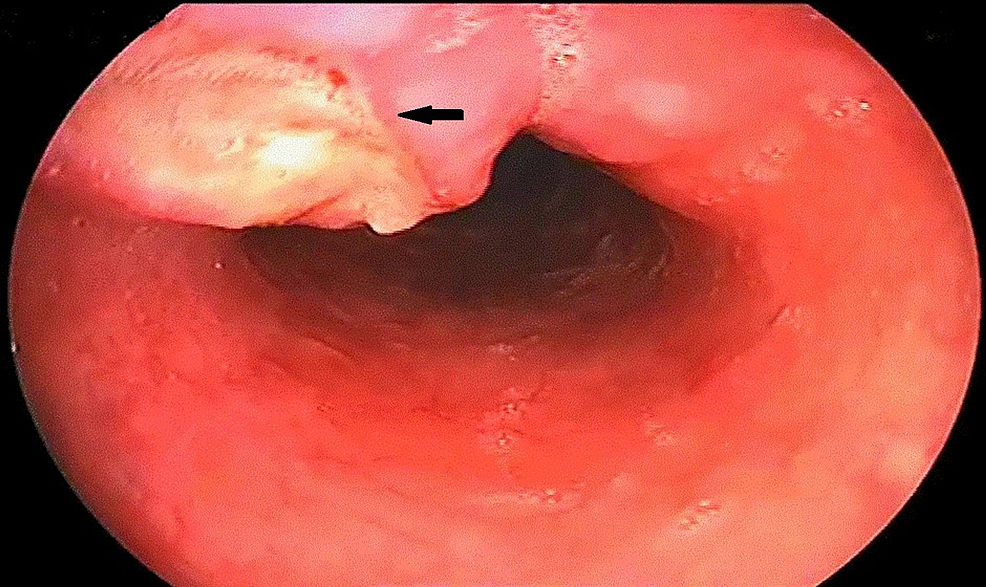 esophagus ulcer